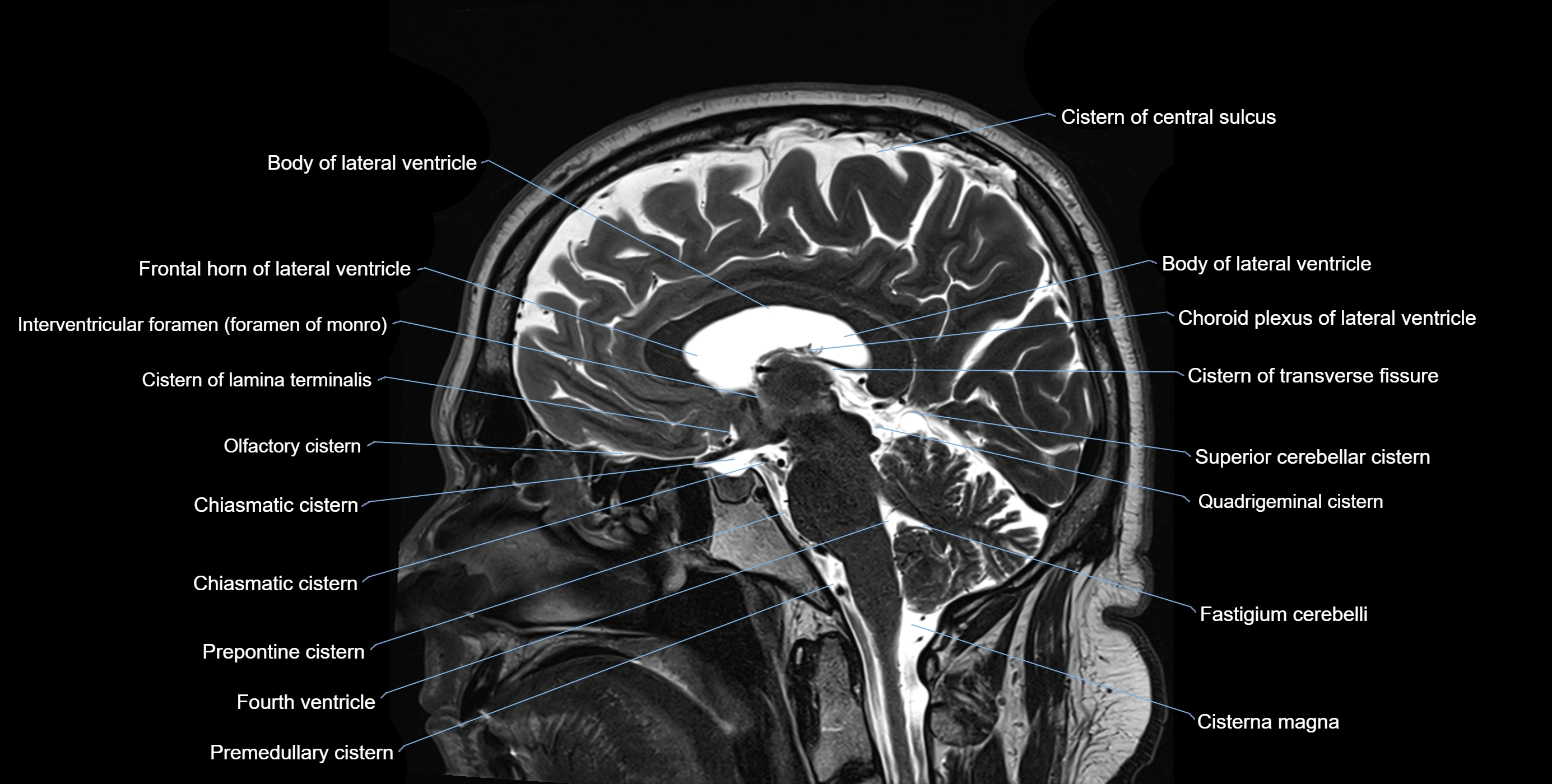 Brain cisterns  and ventricles sagittal anatomy 3T MRI image-img-00001-00027.webp